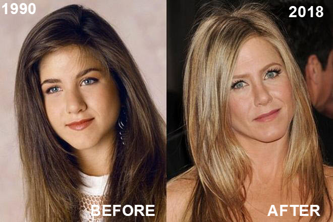 Jennifer Aniston’s Face The Most Requested Celebrity Look In Cosmetic Clinics